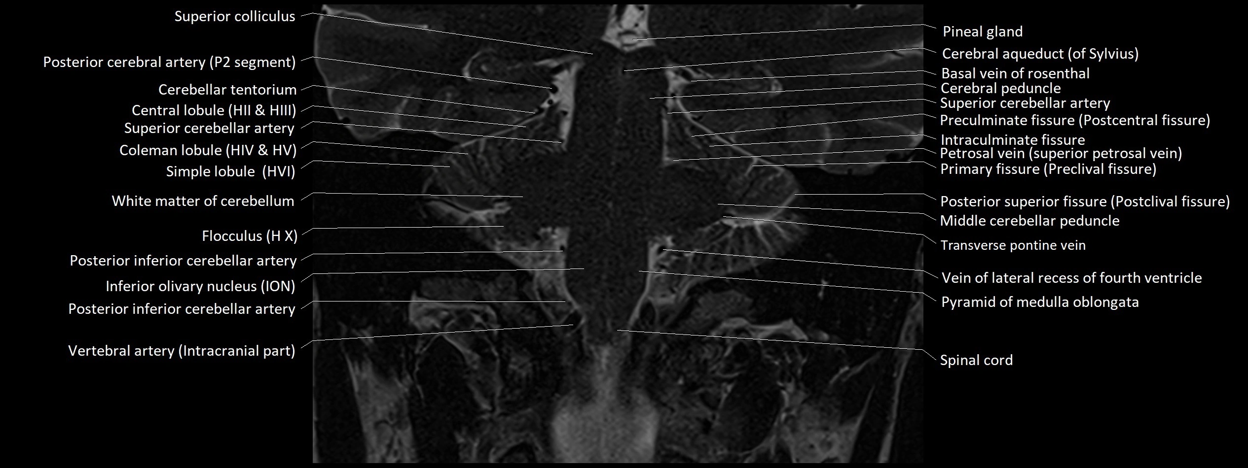 Anatomy of cerebellum coronal cross sectional 3T image 5.webp